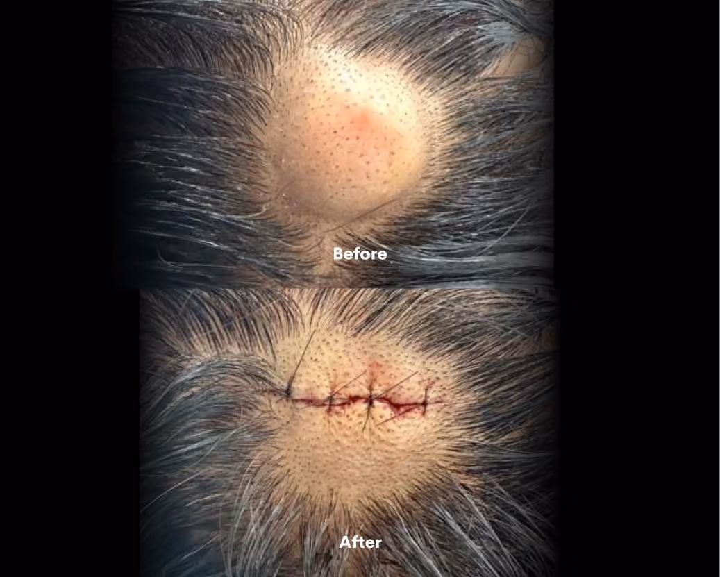 Mole before after
