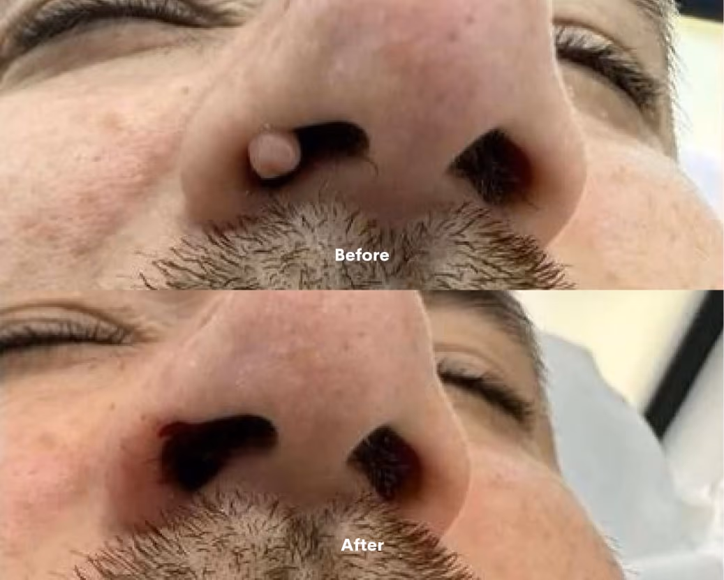Mole before after