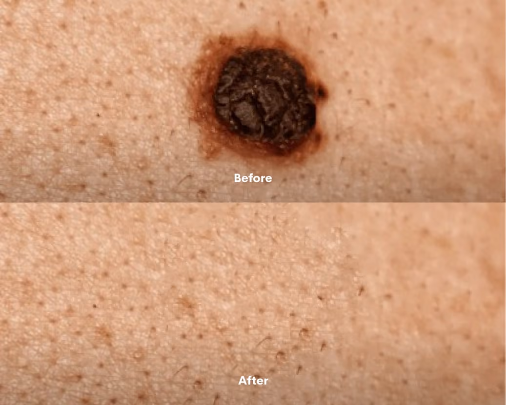 Minor Ops Before After results