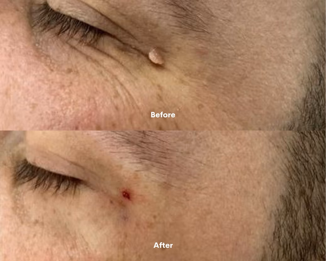 Cyst Removal before after