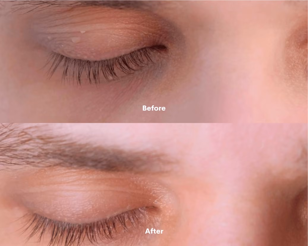 Minor Ops Before After results