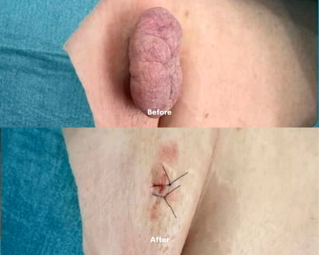 Mole before after