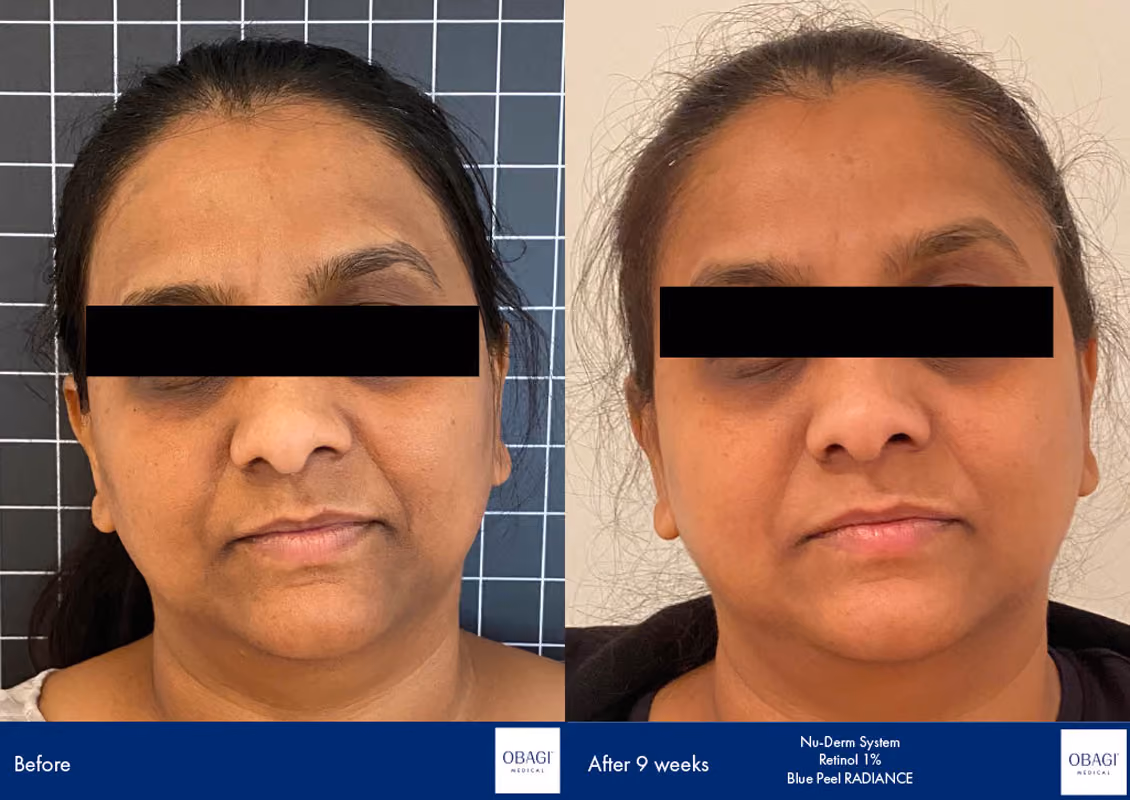 Non-surgical nose job Birmingham