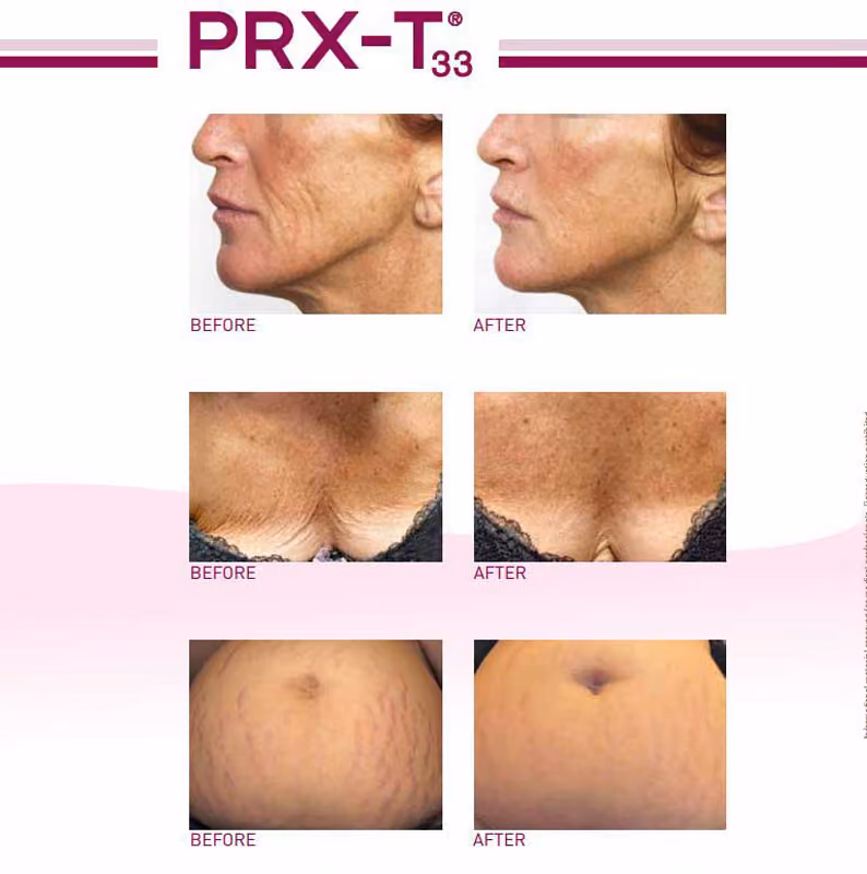 Liquid nose job cost