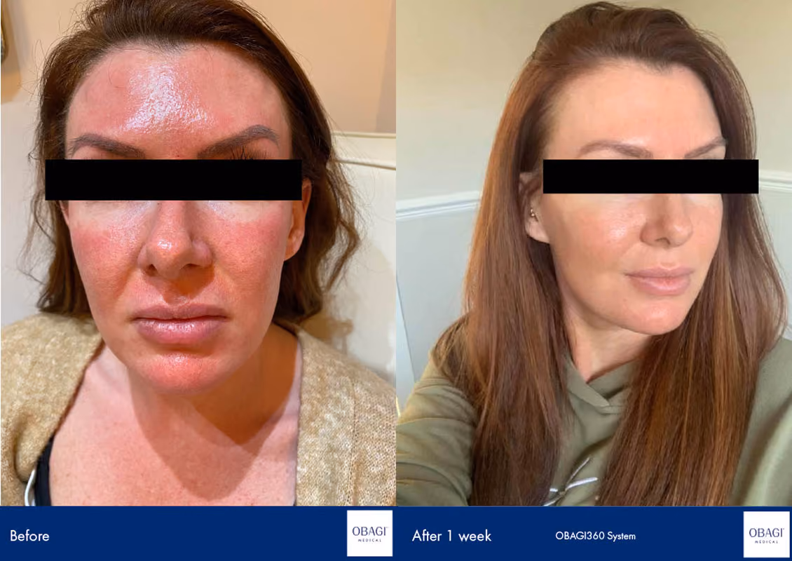 15 min nose job results