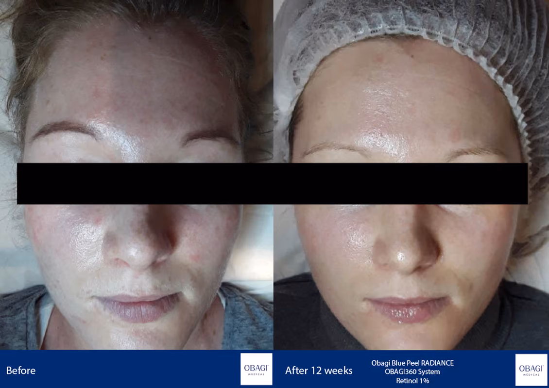 Non surgical nose jobs near me