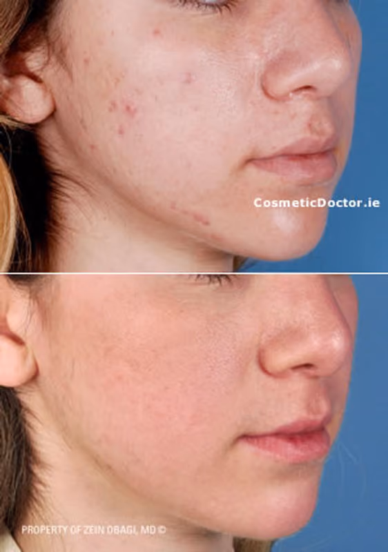 Non surgical nose jobs near me