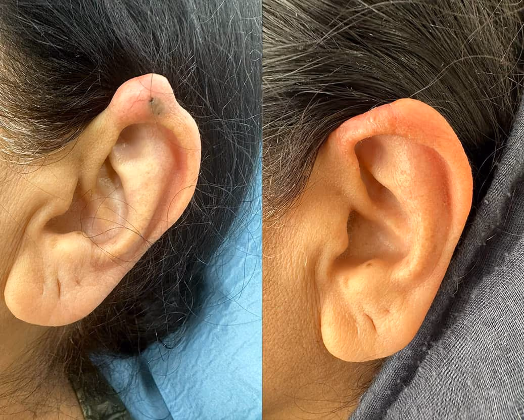 mole before after