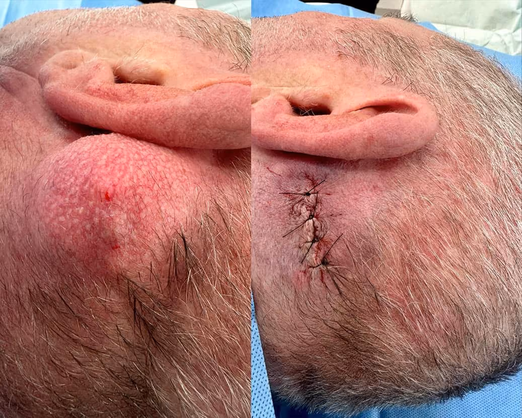 mole before after