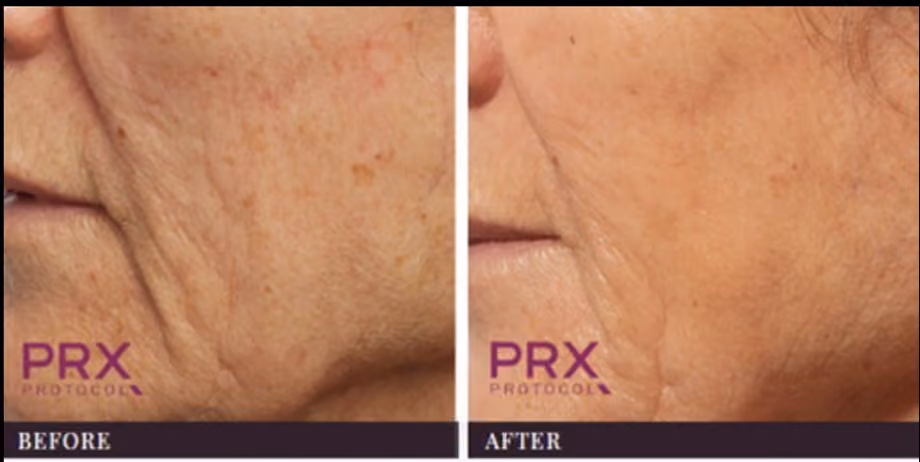 PRX Therapy Before After