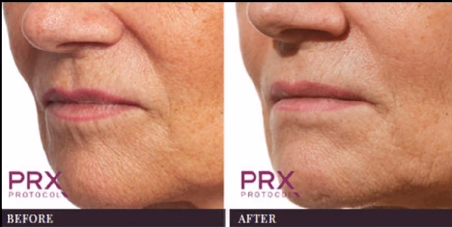 Non-surgical nose job Birmingham