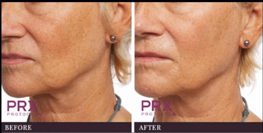 Liquid nose job