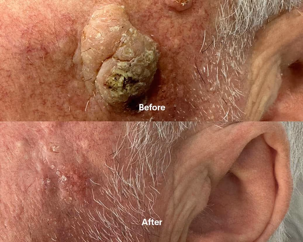 Mole before after