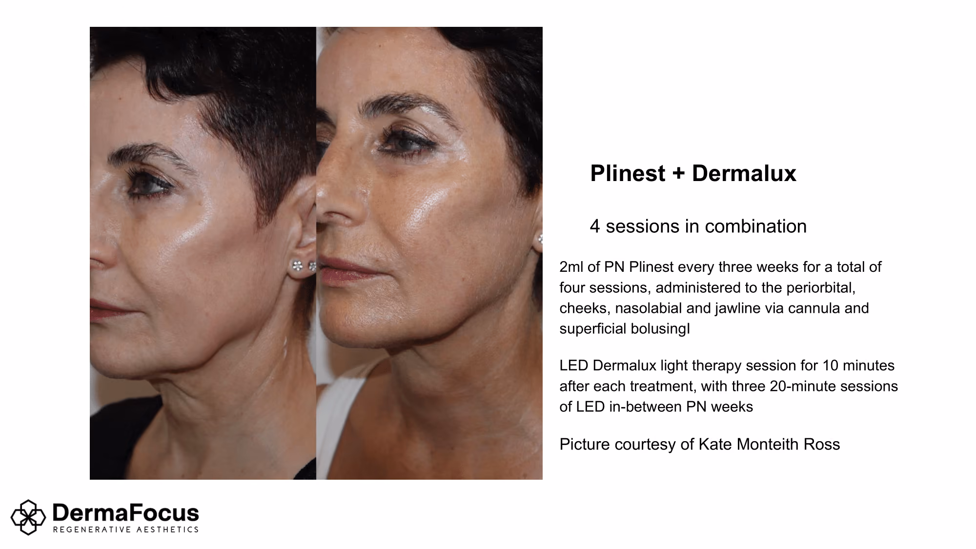 Non surgical nose jobs near me