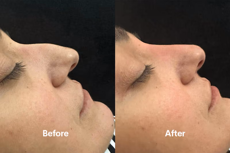 Non-surgical rhinoplasty treatment Solihull clinic