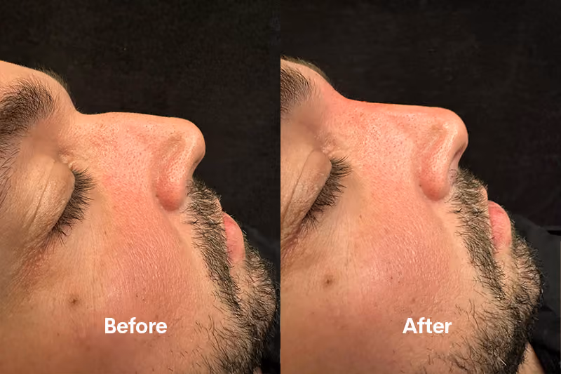 Before and after nose filler Solihull — side profile improvement