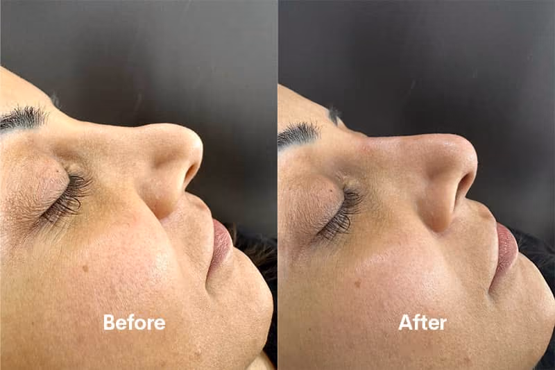 Before and after nose filler Solihull — side profile improvement