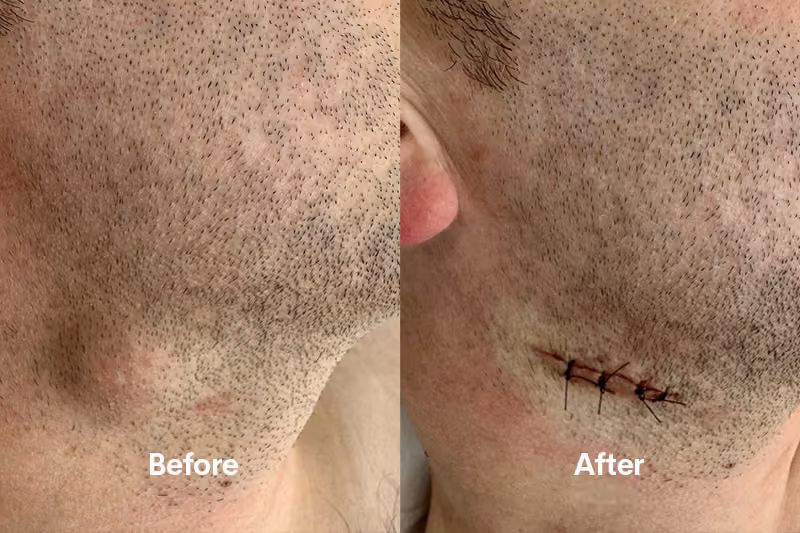 Acne treatment for clearer, healthier-looking skin.