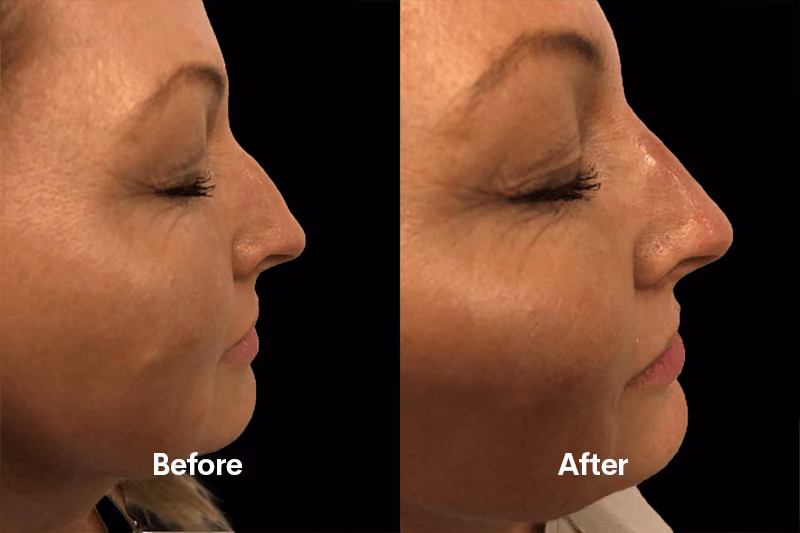 Non-surgical rhinoplasty treatment Solihull clinic”