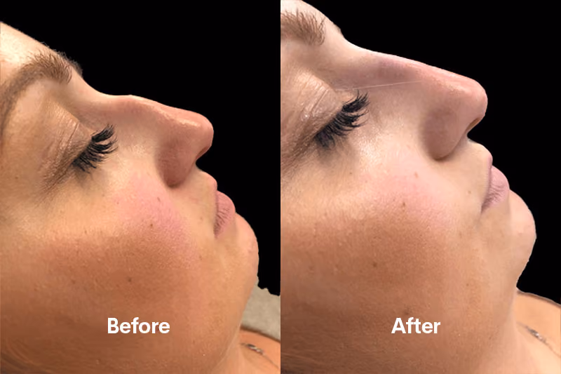 Non-surgical rhinoplasty treatment Solihull clinic”