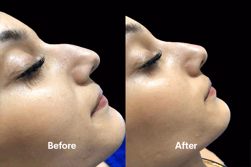 Non-surgical rhinoplasty treatment Solihull clinic