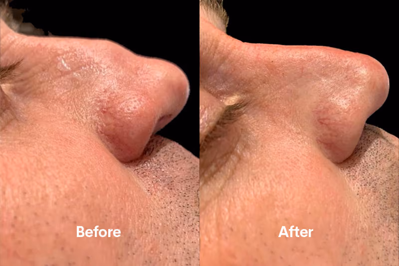 Before and after nose filler Solihull — side profile improvement