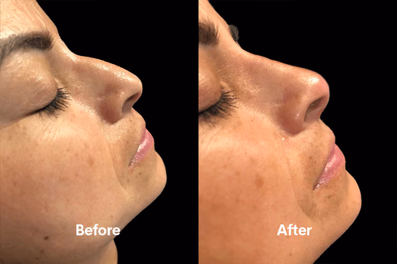 Before and after nose filler Solihull — side profile improvement