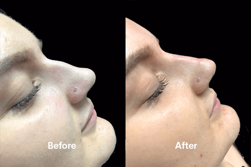Before and after nose filler Solihull — side profile improvement