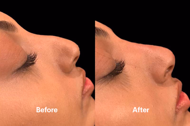 Non-surgical rhinoplasty treatment Solihull clinic”