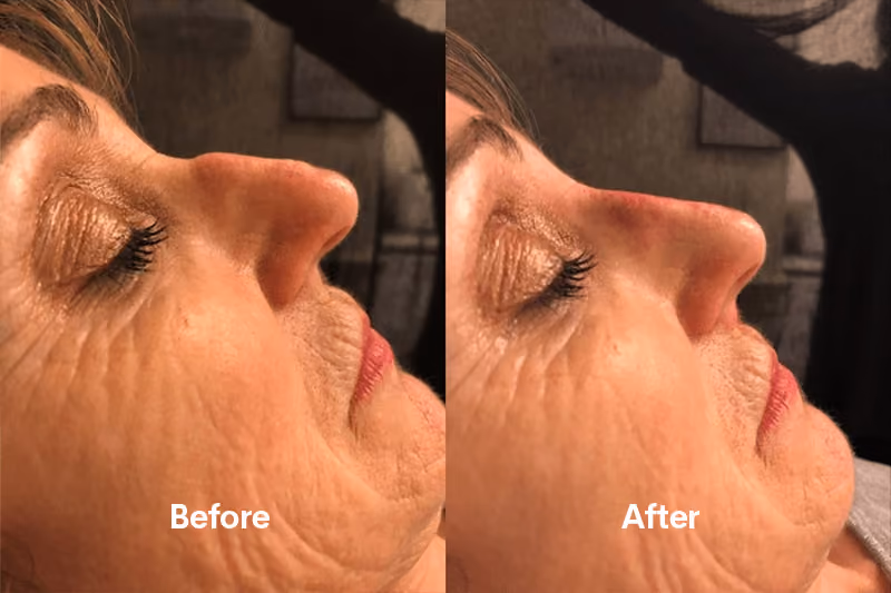 Before and after nose filler Solihull — side profile improvement