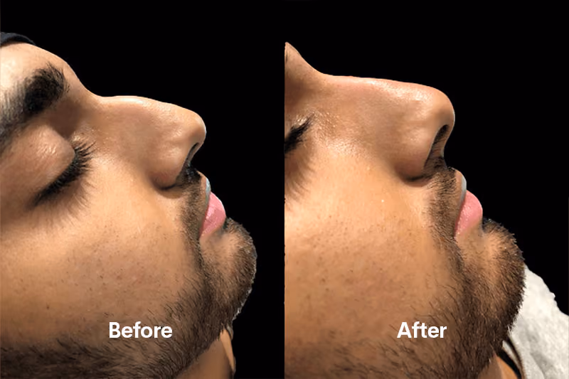 Non-surgical rhinoplasty treatment Solihull clinic