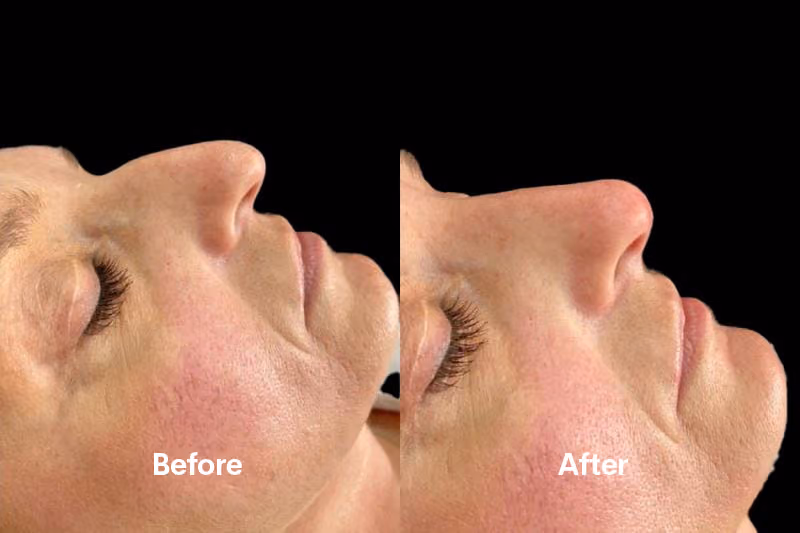Before and after nose filler Solihull — side profile improvement
