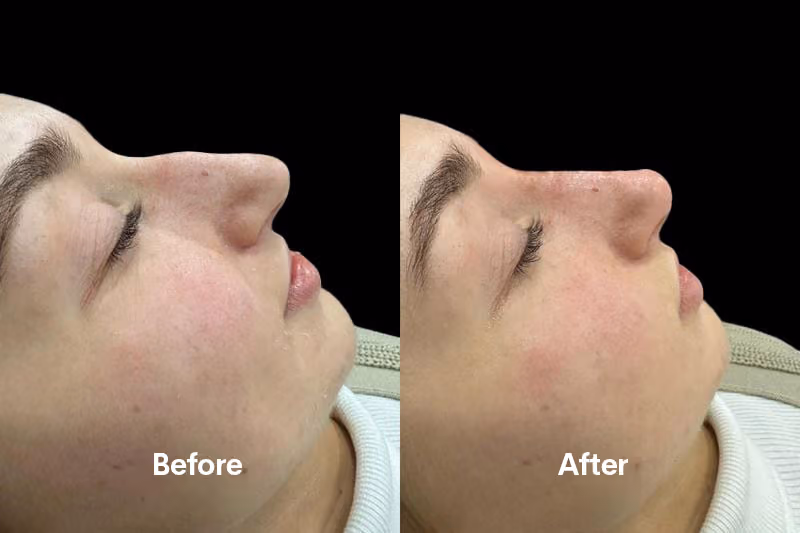 Non-surgical rhinoplasty treatment Solihull clinic”
