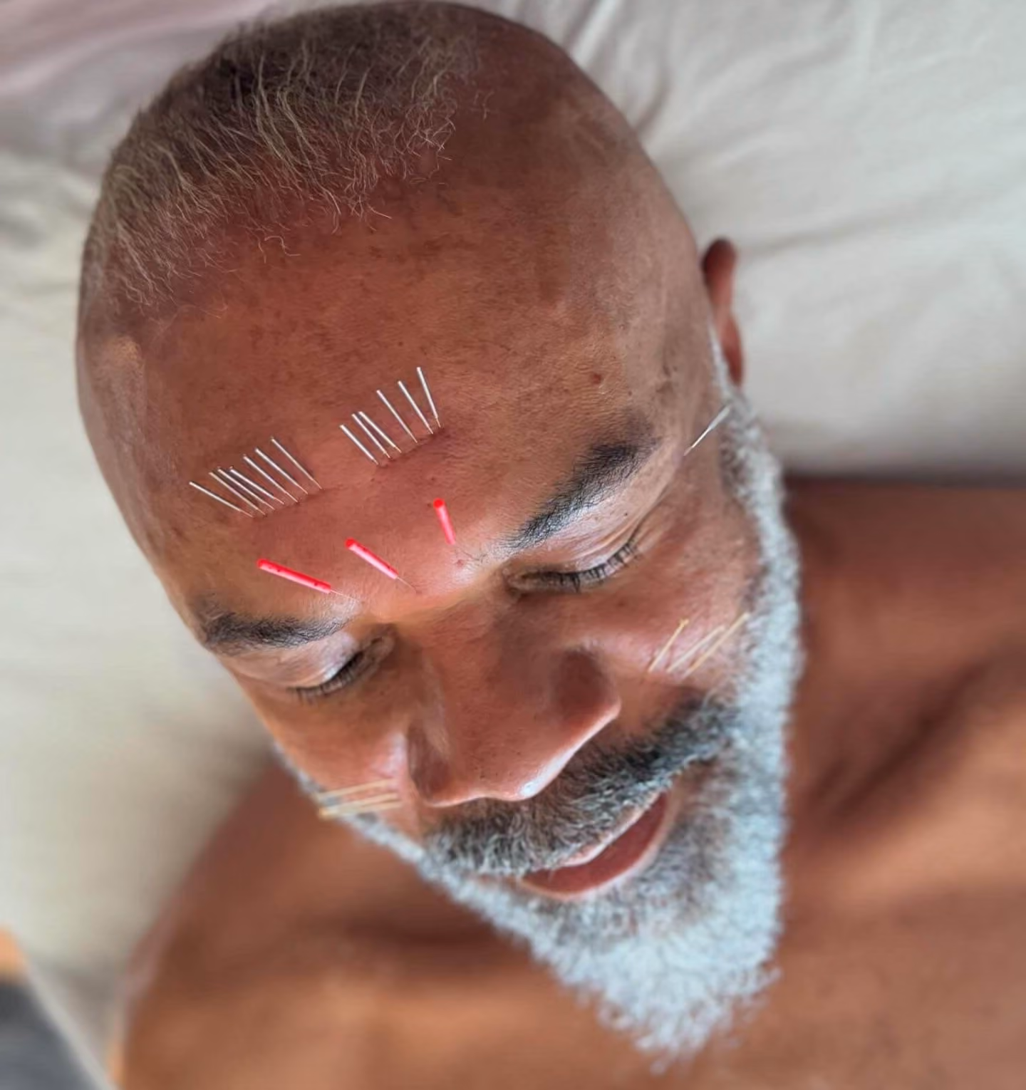 SkinPen Treatment