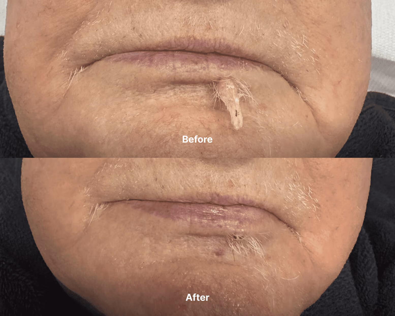 Mole before after