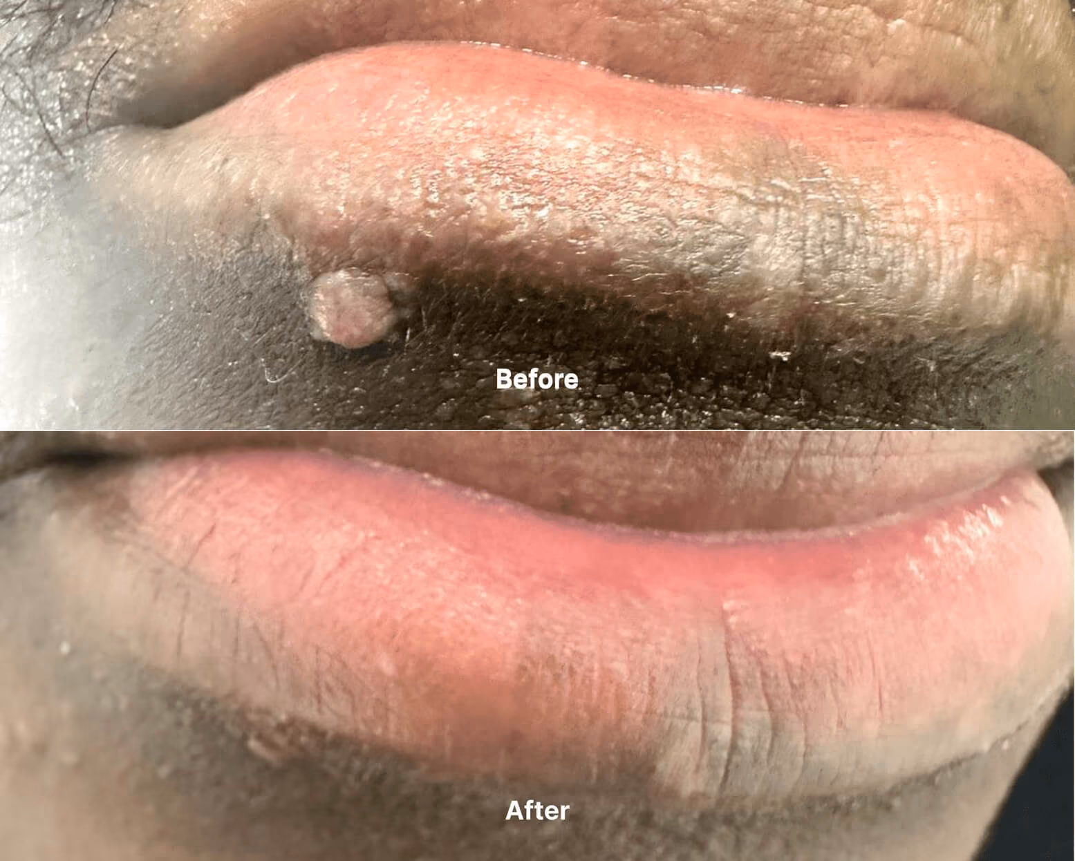 Mole before after