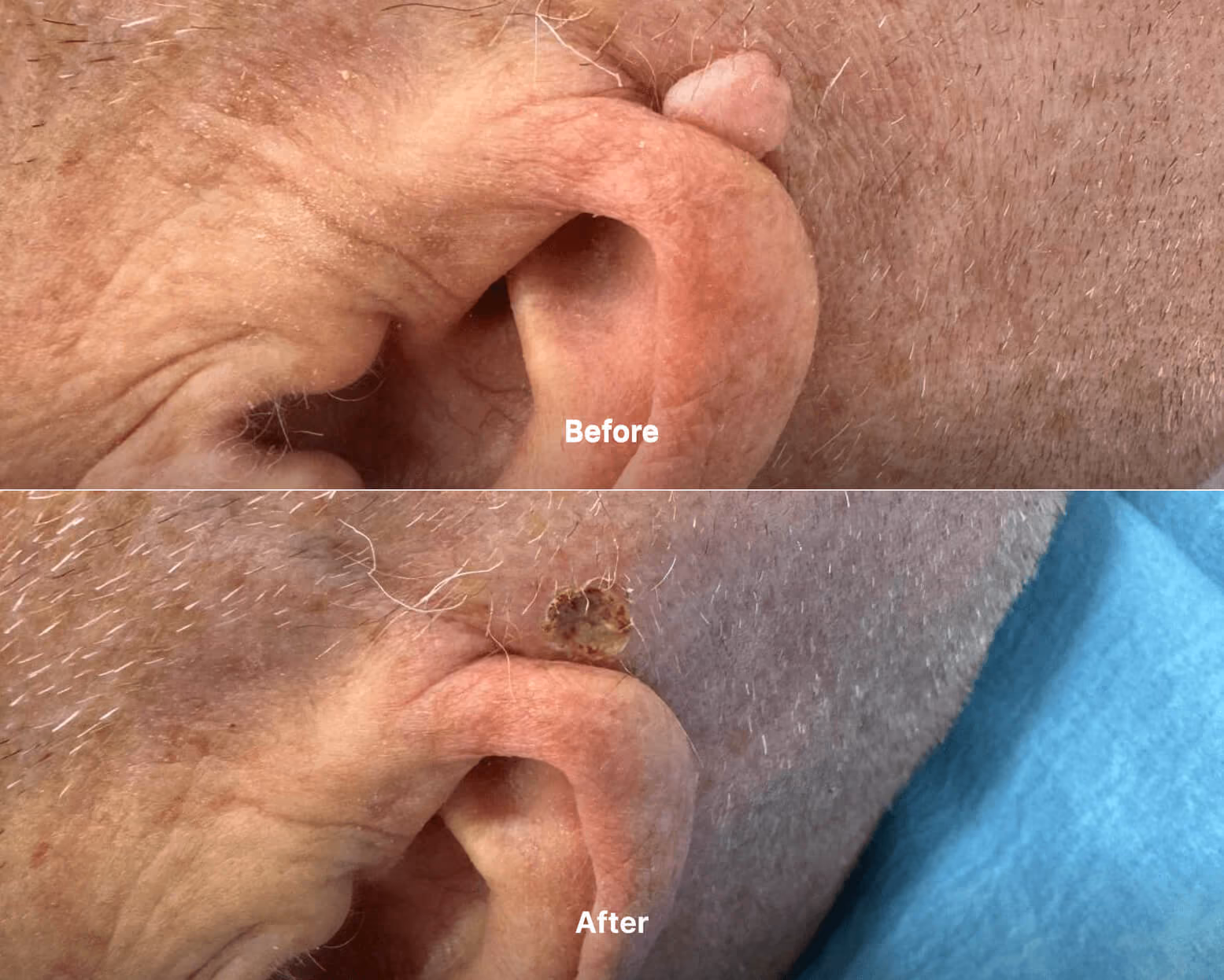 Mole before after