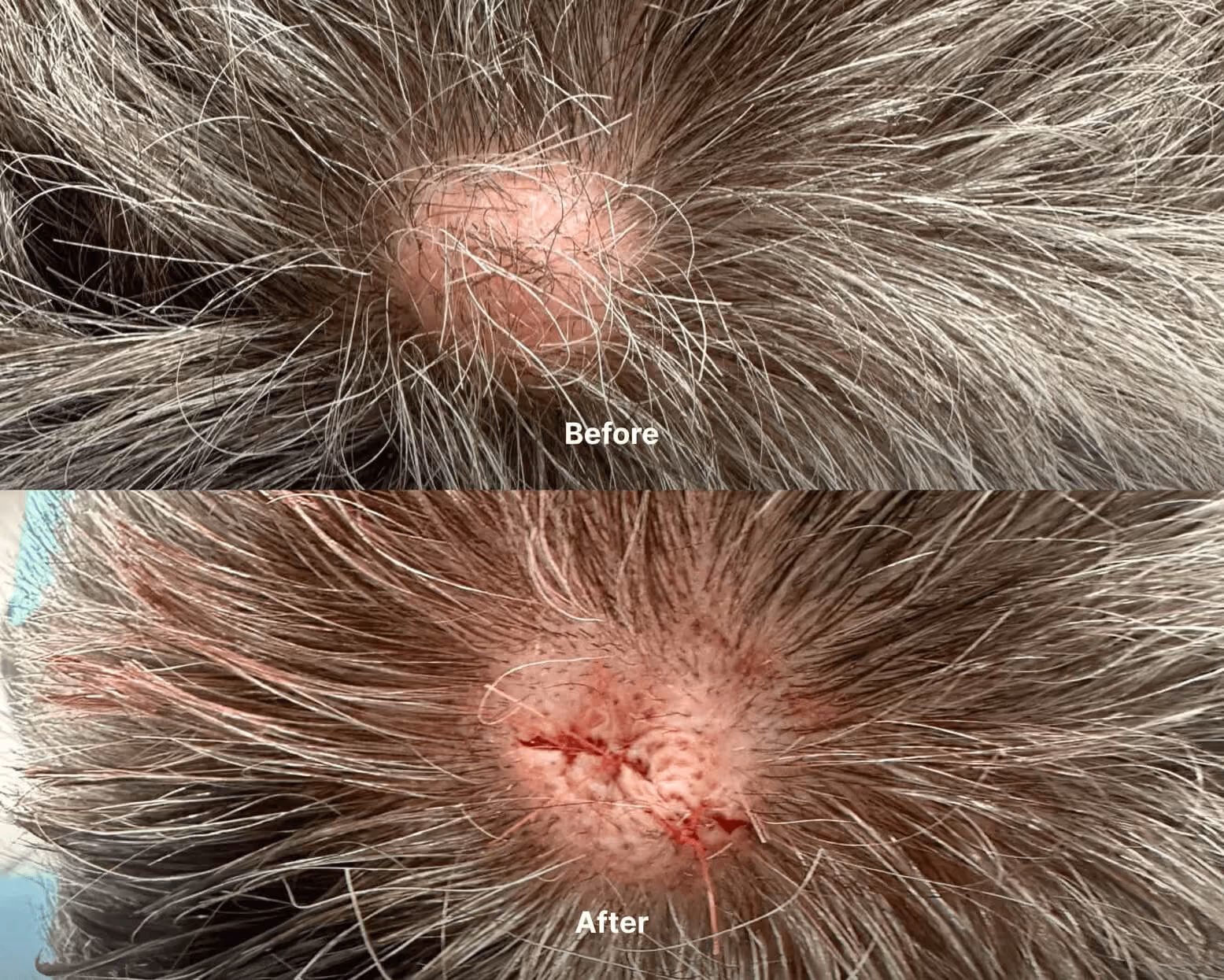 Mole before after