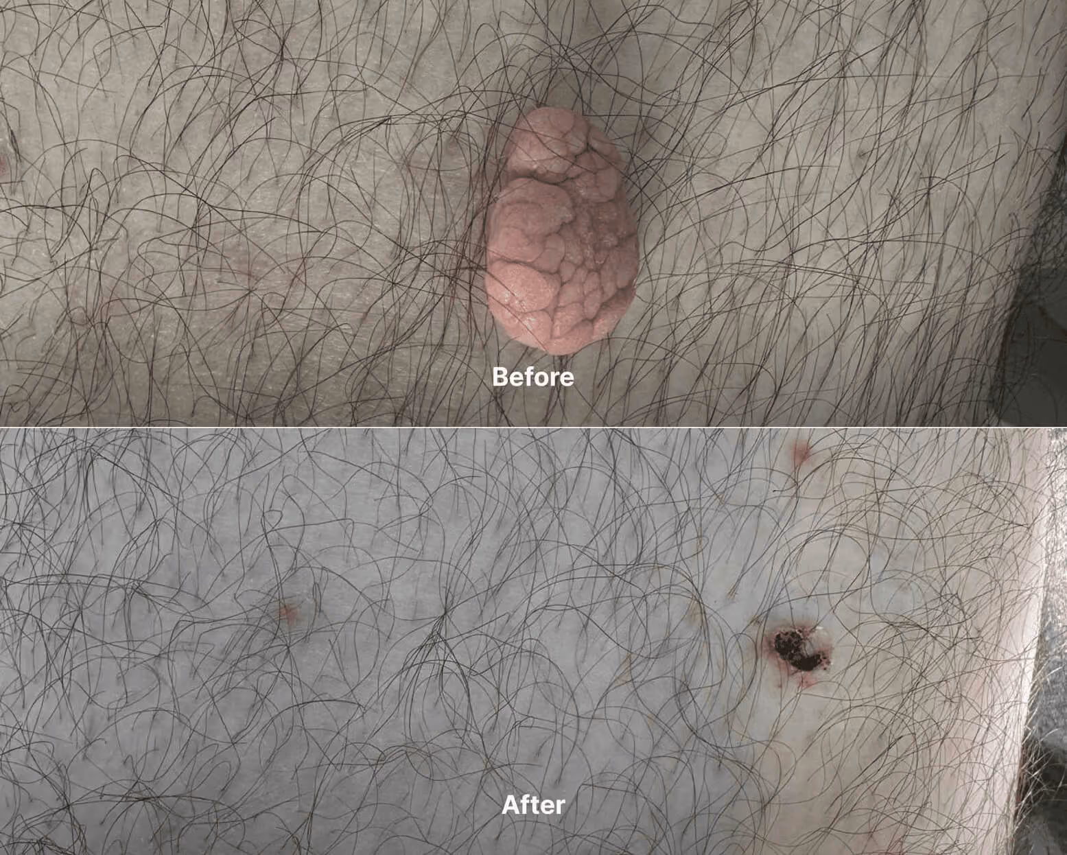 Mole before after