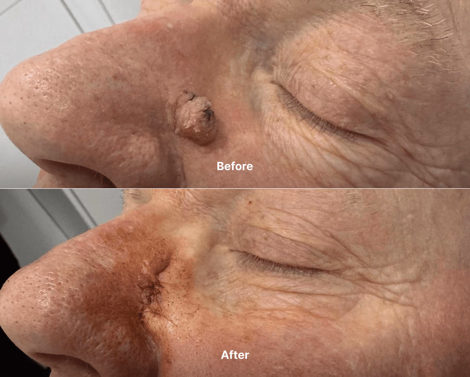 Mole before after