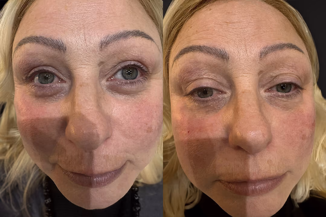 tear trough results