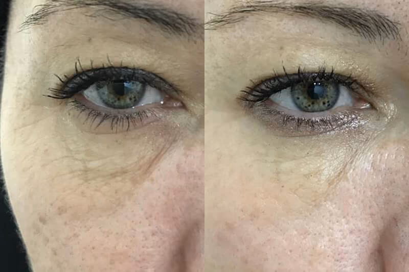 Non-surgical nose job Birmingham