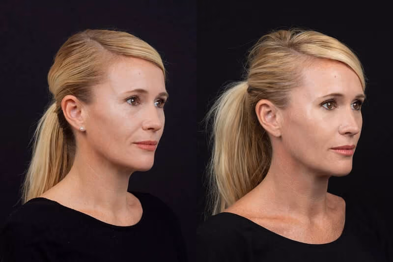 AL Aesthetics Solihull Profhilo consultation