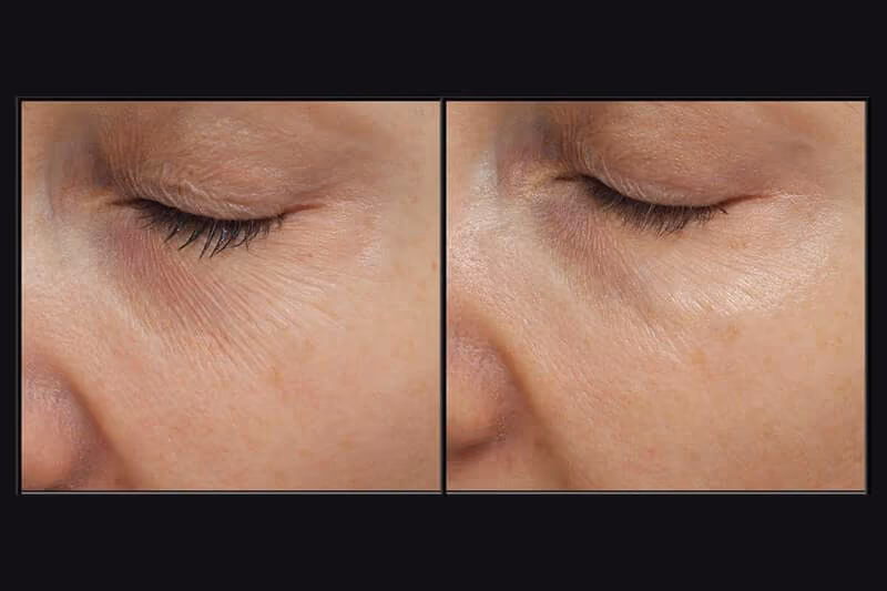 15 min nose job results