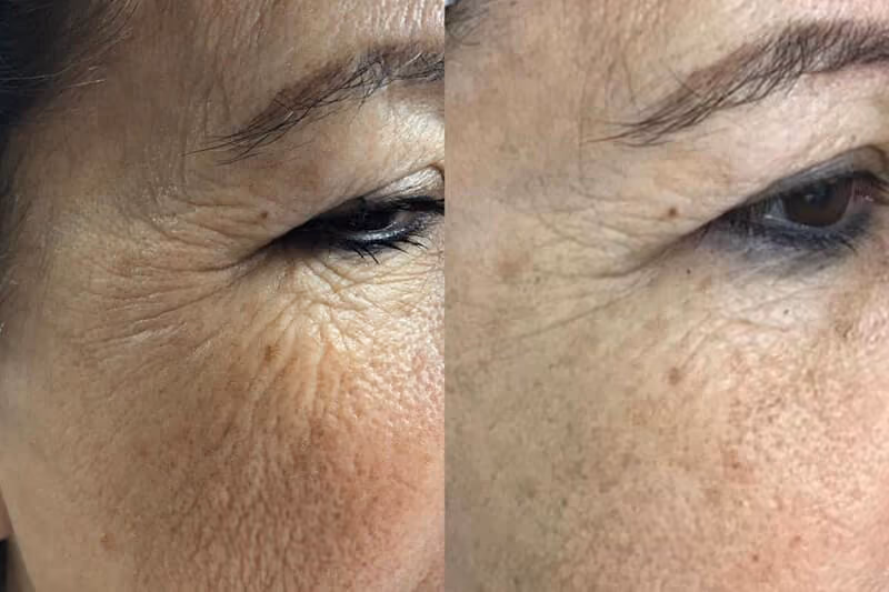 15 min nose job results