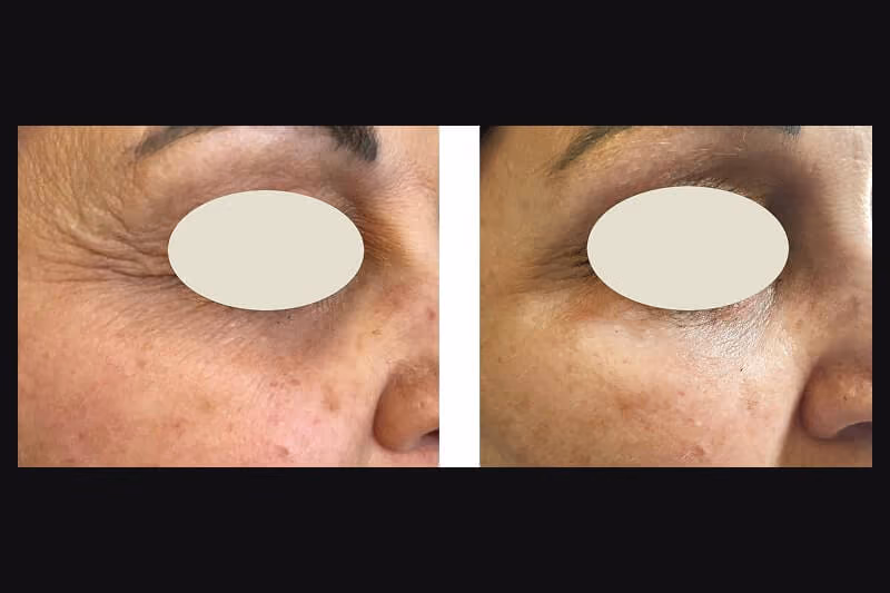 15 min nose job results