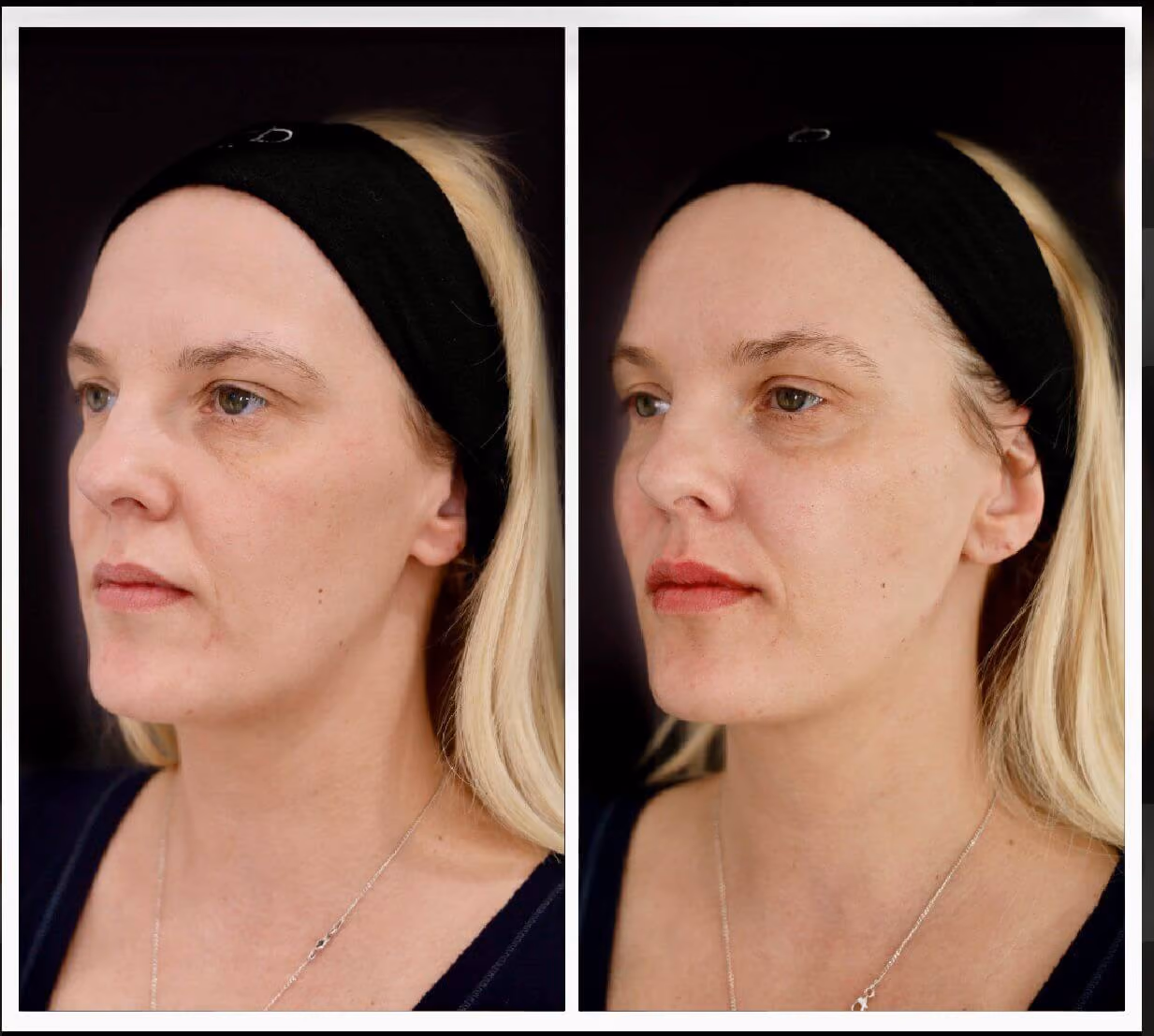Non-surgical facelift in Solihull – 8-point facelift treatment overview