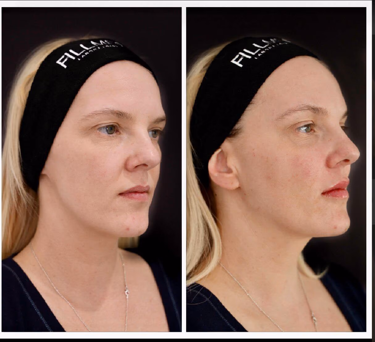 Before and after non-surgical facelift – improved contour and facial support