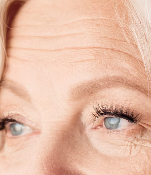 Forehead Lines