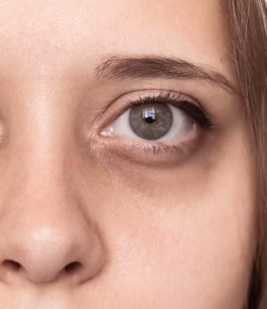 Forehead Lines